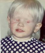 Albino child